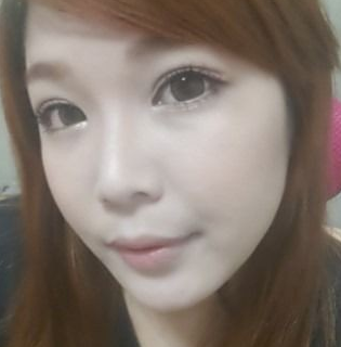 割雙眼皮手術(shù) 就可以這么漂亮 - 珍美網(wǎng)