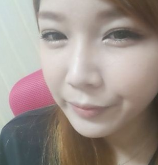 割雙眼皮手術(shù) 就可以這么漂亮 - 珍美網(wǎng)