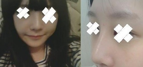 駝峰鼻整形 提升個(gè)人氣質(zhì)杠杠的