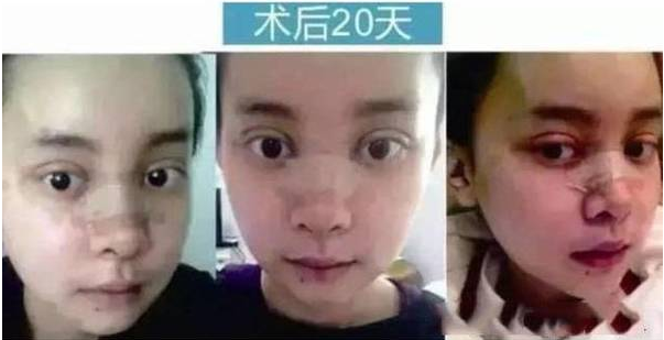 重慶女子花百萬整成anglababy  網(wǎng)友驚呼：太像了！ - 珍美網(wǎng)
