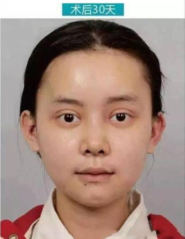 重慶女子花百萬整成anglababy  網(wǎng)友驚呼：太像了！ - 珍美網(wǎng)