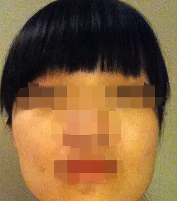 下頜角整形 擁有小臉的我也是很美麗的 - 珍美網(wǎng)