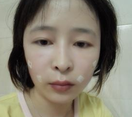 廣州韓妃醫(yī)學(xué)美容門(mén)診部曾繁茂醫(yī)生豐蘋(píng)果肌案例：豐蘋(píng)果肌 - 珍美網(wǎng)