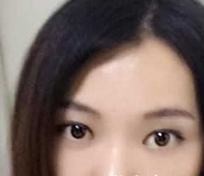 北京凱潤婷醫(yī)療美容醫(yī)院趙洋醫(yī)生嫩膚案例:我的彩光嫩膚歷程 - 珍美網(wǎng)