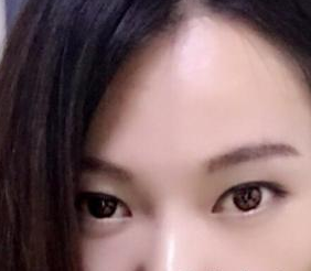 北京凱潤婷醫(yī)療美容醫(yī)院趙洋醫(yī)生嫩膚案例:我的彩光嫩膚歷程 - 珍美網(wǎng)