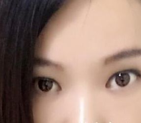 北京凱潤婷醫(yī)療美容醫(yī)院趙洋醫(yī)生嫩膚案例:我的彩光嫩膚歷程 - 珍美網(wǎng)