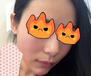 玻尿酸面部填充 讓我更加美麗