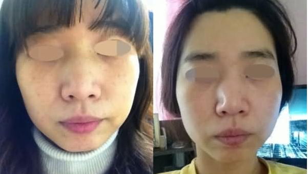 青島永緣韓美整形美容診所李太卿醫(yī)生美白案例:美白美容