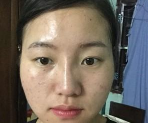 蘇州工業(yè)園區(qū)瑞芙臣醫(yī)療美容診所徐增亮醫(yī)生豐全臉案例:面部填充 - 珍美網(wǎng)