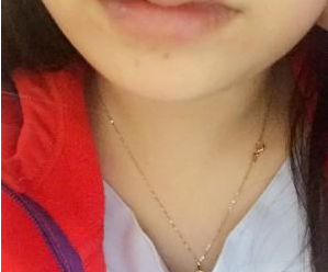 長沙雅美醫(yī)療美容醫(yī)院袁妍妍醫(yī)生豐唇案例：嘟嘟唇 - 珍美網(wǎng)