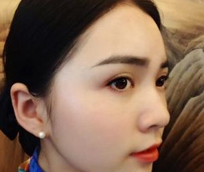 隆鼻整形 我才發(fā)現(xiàn)自己的美越來越驚艷了 - 珍美網(wǎng)