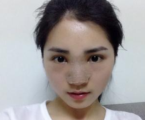 隆鼻整形 我才發(fā)現(xiàn)自己的美越來越驚艷了 - 珍美網(wǎng)