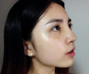 隆鼻整形 我才發(fā)現(xiàn)自己的美越來越驚艷了 - 珍美網(wǎng)