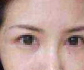注射豐臥蠶 怎么樣都很美 - 珍美網