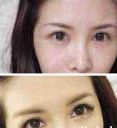 注射豐臥蠶 怎么樣都很美 - 珍美網