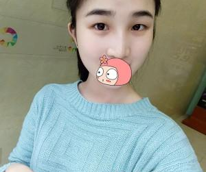 隆鼻手術(shù) 讓我氣質(zhì)越來越好啦 - 珍美網(wǎng)