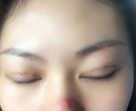 長春南關(guān)區(qū)銘妍醫(yī)療美容部莊璐醫(yī)生割雙眼皮案例:割雙眼皮 - 珍美網(wǎng)