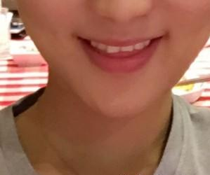 溫州友好醫(yī)院尹建祥醫(yī)生墊下巴案例：細(xì)心記錄我的玻尿酸豐下巴經(jīng)