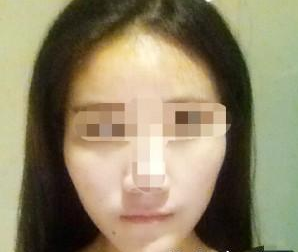 武漢伊美馨醫(yī)療美容門診部黃蕾醫(yī)生墊下巴案例:今天終于去打玻尿 - 珍美網(wǎng)