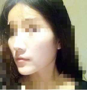 武漢伊美馨醫(yī)療美容門診部黃蕾醫(yī)生墊下巴案例:今天終于去打玻尿 - 珍美網(wǎng)