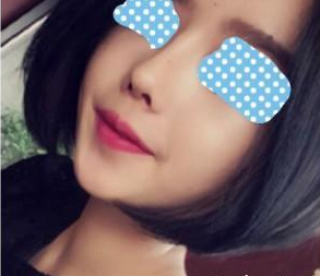 北京歐揚(yáng)醫(yī)療美容門診部薄濱醫(yī)生隆鼻案例:玻尿酸隆鼻 - 珍美網(wǎng)