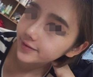北京歐揚(yáng)醫(yī)療美容門診部薄濱醫(yī)生隆鼻案例:玻尿酸隆鼻 - 珍美網(wǎng)