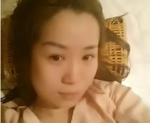 北京衛(wèi)人中醫(yī)醫(yī)院閆國(guó)劍醫(yī)生豐全臉案例:玻尿酸面部填充 - 珍美網(wǎng)