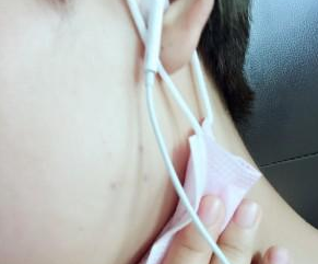 金華商業(yè)整形美容葉彩娣醫(yī)生瘦臉案例:瘦臉 - 珍美網(wǎng)