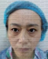 成都溫江達拉斯整形美容診所嚴新醫(yī)生去眼袋案例:外切眼袋 - 珍美網(wǎng)