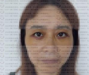 成都溫江達拉斯整形美容診所嚴新醫(yī)生去眼袋案例:外切眼袋 - 珍美網(wǎng)
