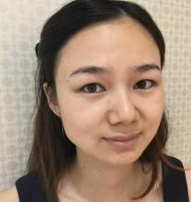 長(zhǎng)沙美研醫(yī)療美容門(mén)診部張彬醫(yī)生瘦臉案例:瘦臉針 - 珍美網(wǎng)