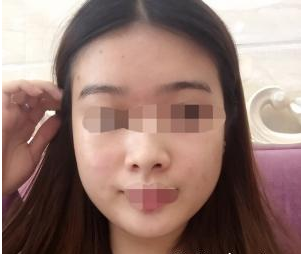 深圳晨曦醫(yī)療美容門(mén)診部朱春艷醫(yī)生瘦臉案例:瘦臉針 - 珍美網(wǎng)