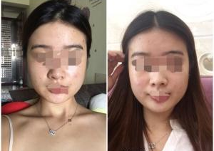 深圳晨曦醫(yī)療美容門(mén)診部朱春艷醫(yī)生瘦臉案例:瘦臉針 - 珍美網(wǎng)