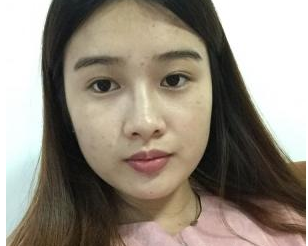 深圳晨曦醫(yī)療美容門診部朱春艷醫(yī)生瘦臉案例：瘦臉針
