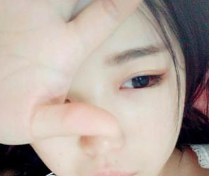 北京葉美人醫(yī)療美容診所余森林醫(yī)生割雙眼皮案例:人都夸我美美了 - 珍美網(wǎng)