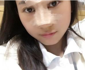 重慶星宸美容醫(yī)院彭紹宗醫(yī)生鼻部綜合整形案例:我的小翹鼻 - 珍美網(wǎng)