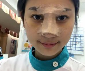 重慶星宸美容醫(yī)院彭紹宗醫(yī)生鼻部綜合整形案例:我的小翹鼻 - 珍美網(wǎng)