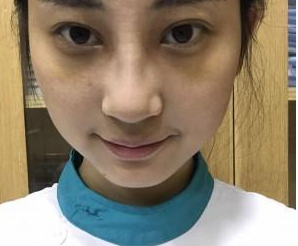 重慶星宸美容醫(yī)院彭紹宗醫(yī)生鼻部綜合整形案例:我的小翹鼻 - 珍美網(wǎng)