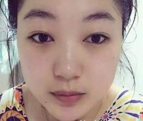 上海美爾雅醫(yī)療美容門診部劉榮升醫(yī)生瘦臉案例：效果好，大臉秒變