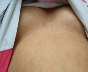 深圳匯仁整形美容門診部陳洪醫(yī)生隆胸案例:自體脂肪填充第一次 - 珍美網(wǎng)