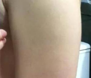 手臂吸脂 比例平衡的手臂也很美麗 - 珍美網(wǎng)
