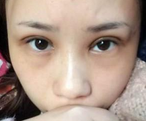 雙眼皮手術(shù) 眼睛更加迷人好看 - 珍美網(wǎng)