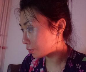 面部填充 美麗離我也不是很遠 - 珍美網(wǎng)
