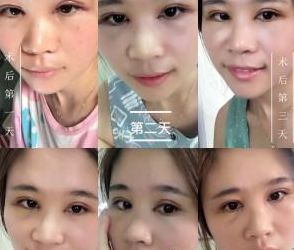 割雙眼皮手術(shù) 讓我更加美麗動(dòng)人 - 珍美網(wǎng)