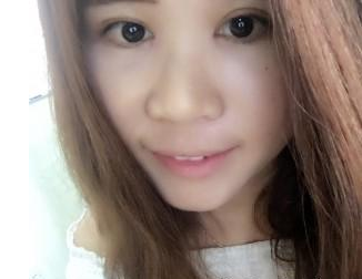 割雙眼皮手術(shù) 讓我更加美麗動(dòng)人