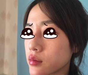 玻尿酸注射面部 臉部活力又顯得年輕了 - 珍美網(wǎng)