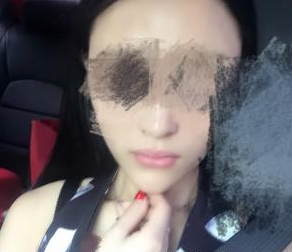 玻尿酸注射全臉 美麗離我更近一步了 - 珍美網(wǎng)