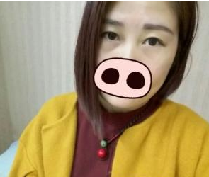 玻尿酸填充多個部位 寶媽也能夠還原當(dāng)初的美麗 - 珍美網(wǎng)