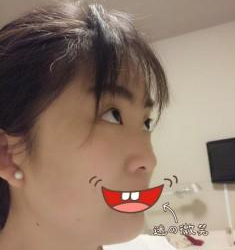 雙眼皮手術(shù) 面部整體看起來(lái)美膩好多啊 - 珍美網(wǎng)