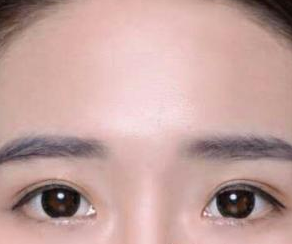 雙眼皮手術(shù) 看著鏡里的自己好看的差點愛上自己 - 珍美網(wǎng)